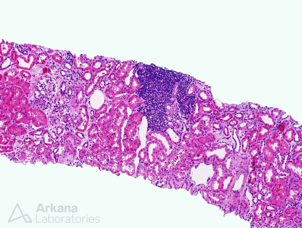 lymphoid aggregates, diagnosis, arkana laboratories, pathology