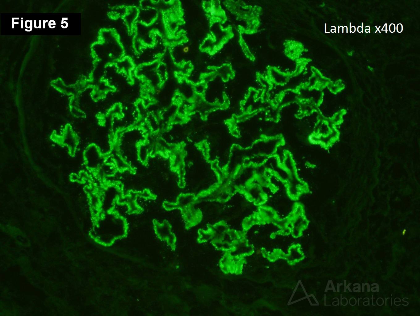 Membranous Nephropathy After Transplantation