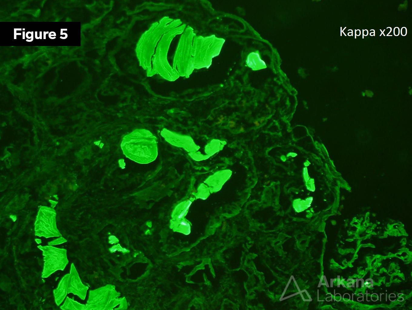 Light Chain Cast Nephropathy