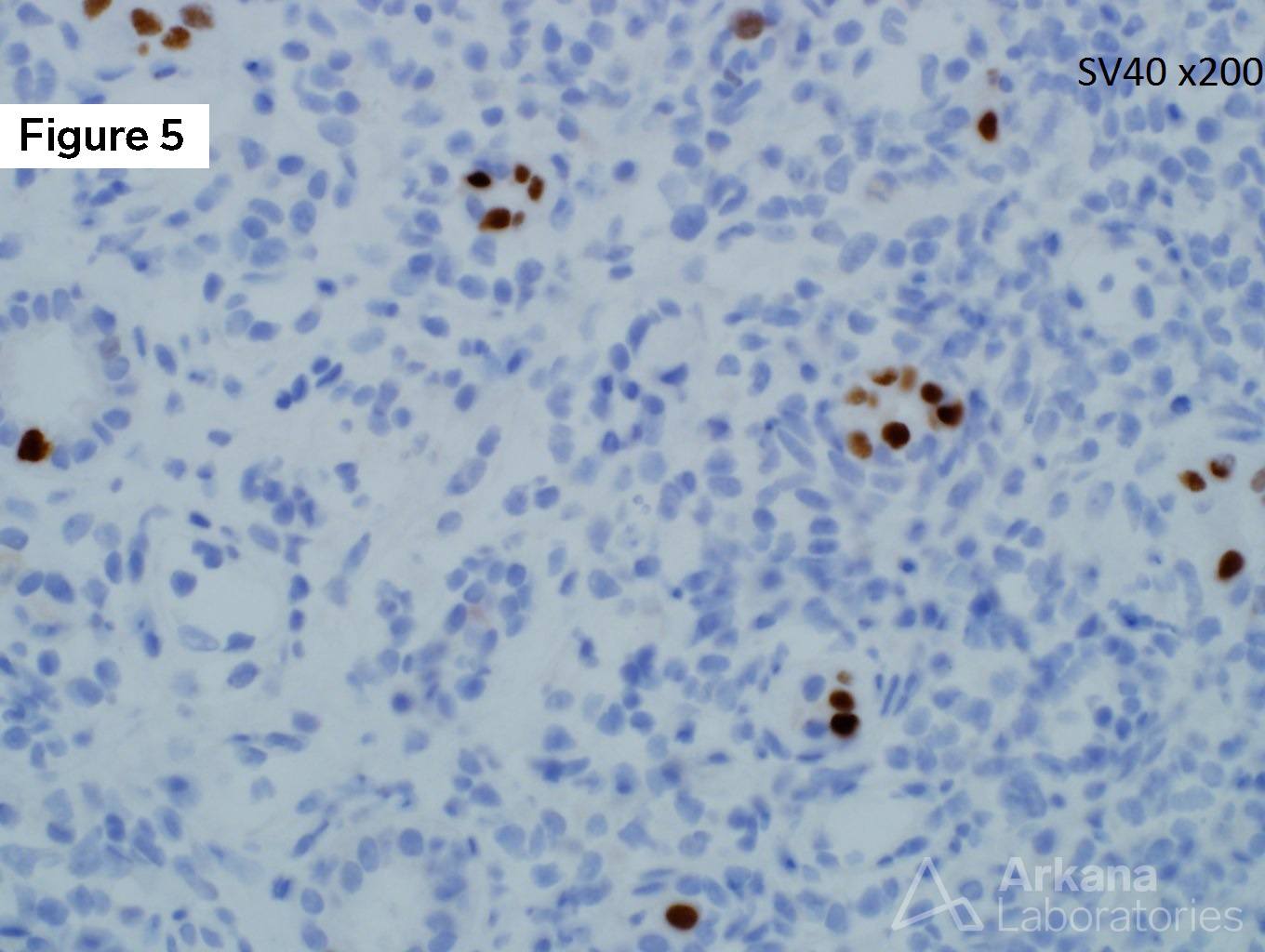 BK Nephritis