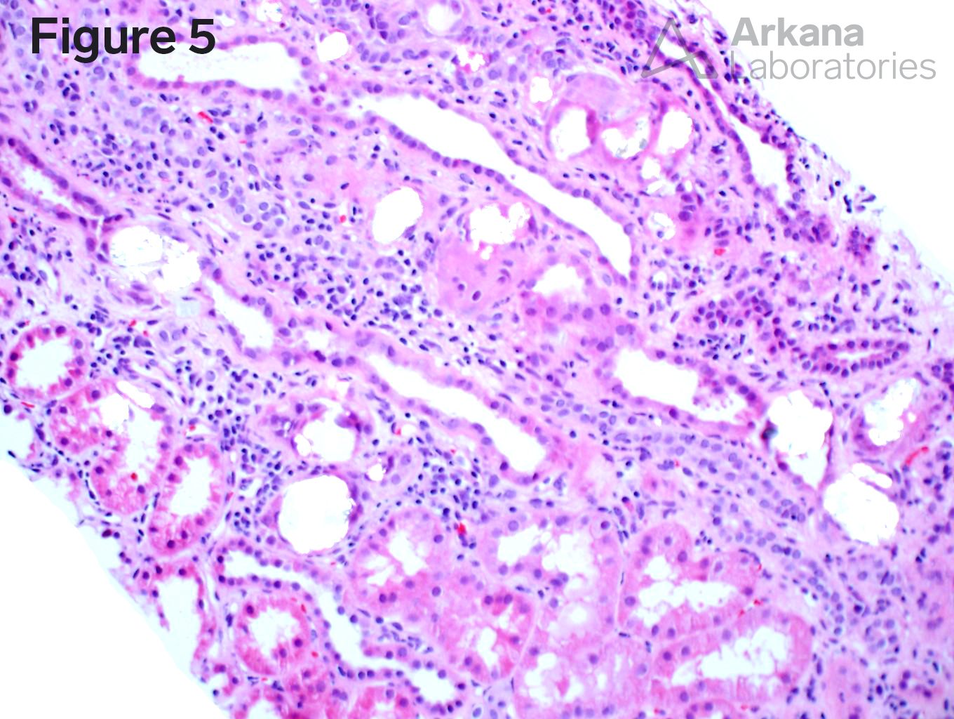 Renal oxalosis