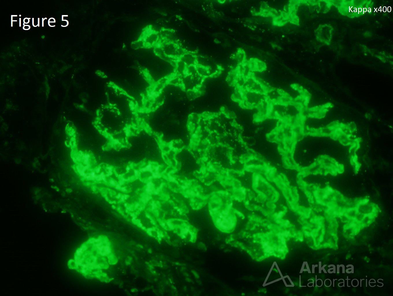 Lupus Nephritis