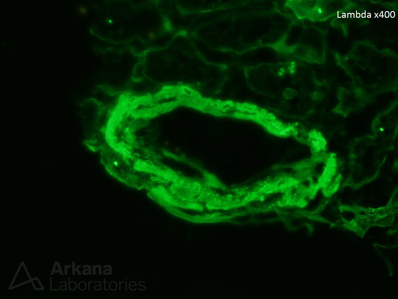 AL Amyloidosis