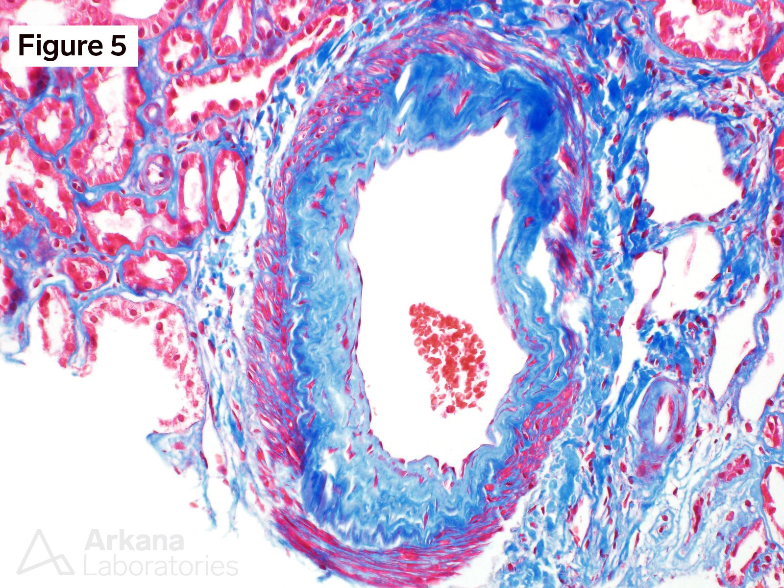 VEGF Inhibitor