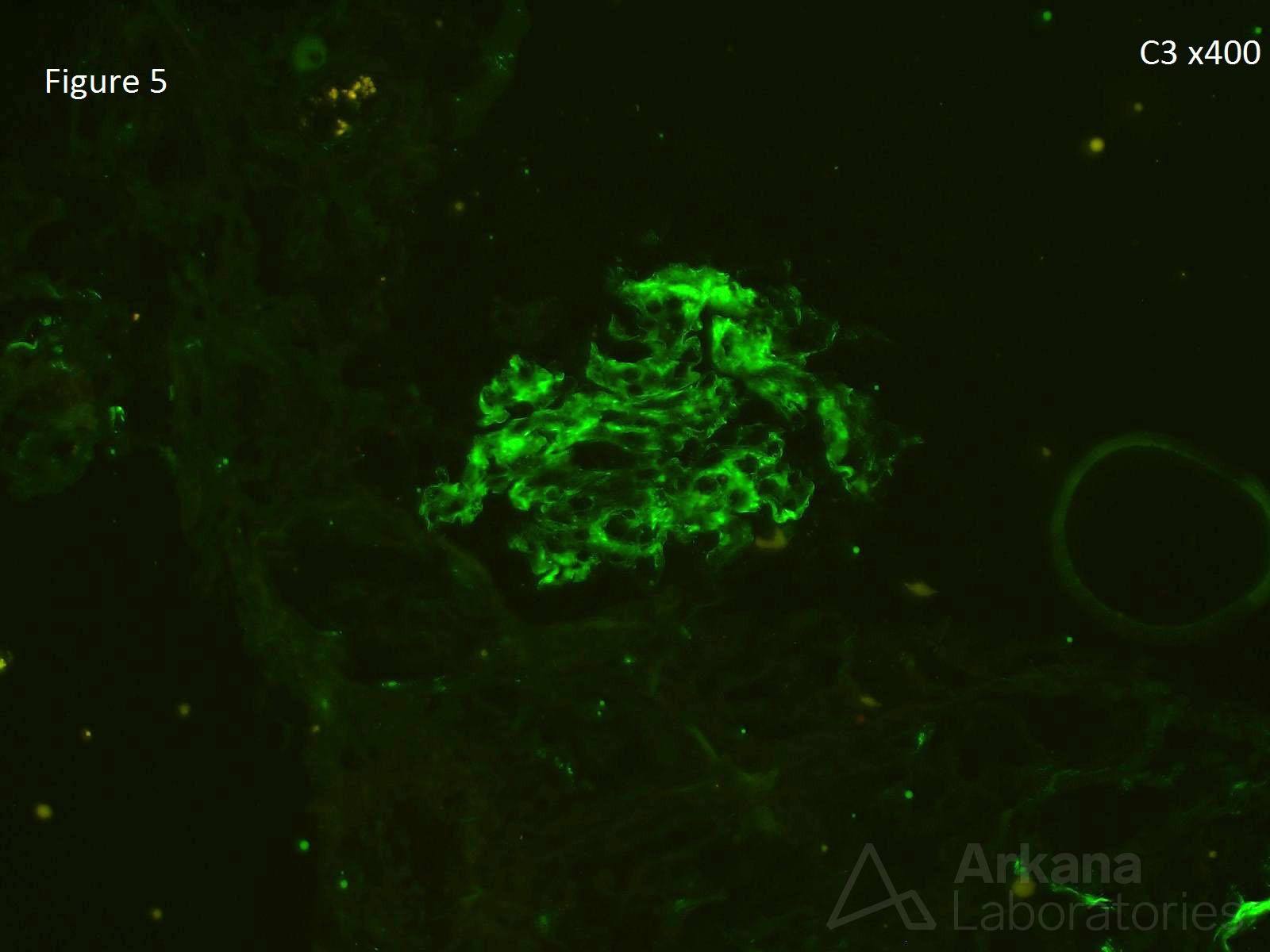 Cryoglobulinemic Glomerulonephritis