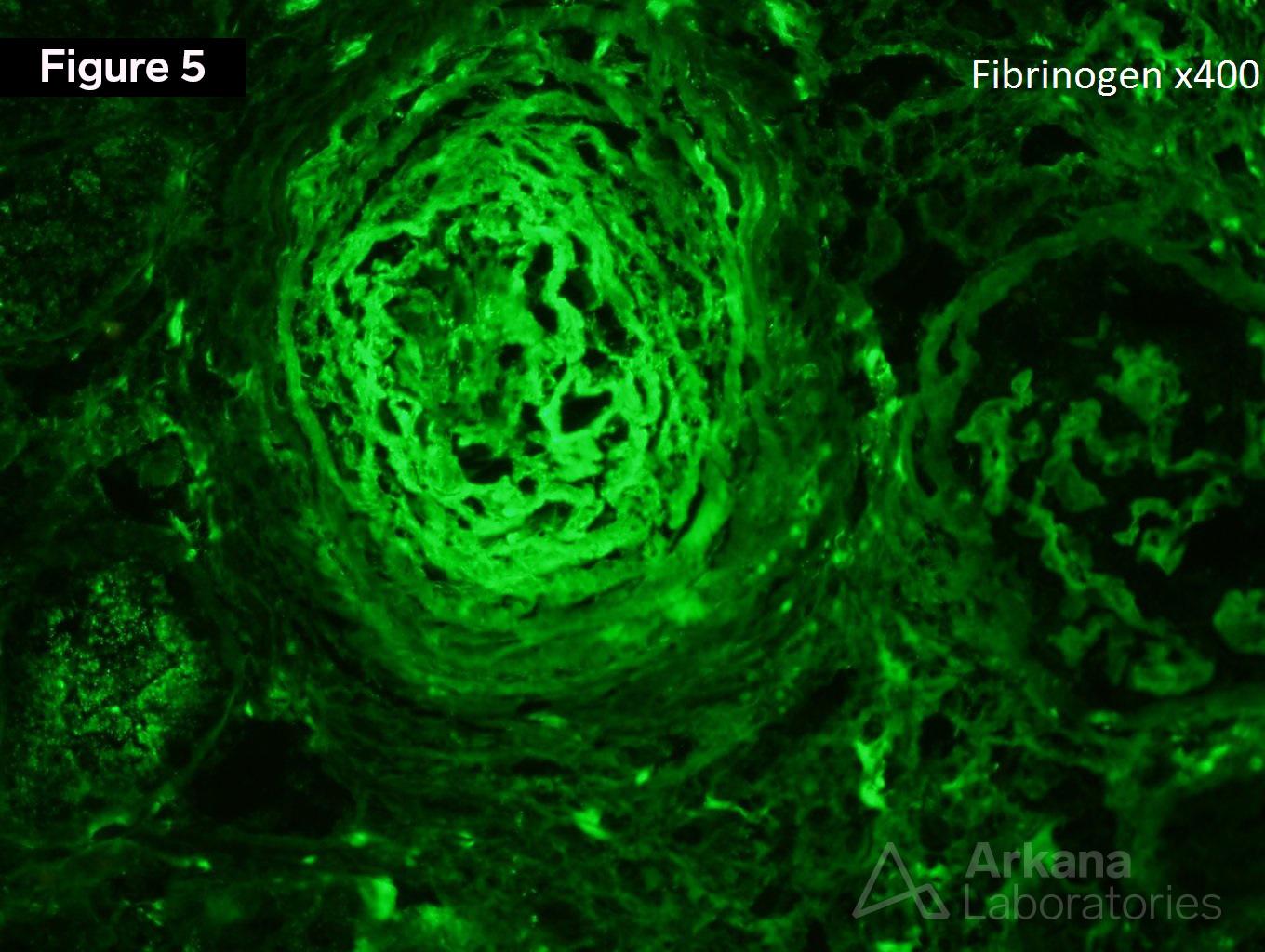 Scleroderma