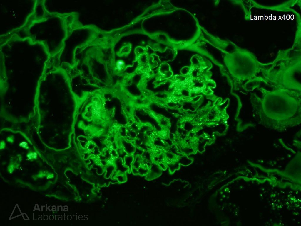 Lambda stain on kidney biopsy, IgA Dominant Infection-Associated Glomerulonephritis