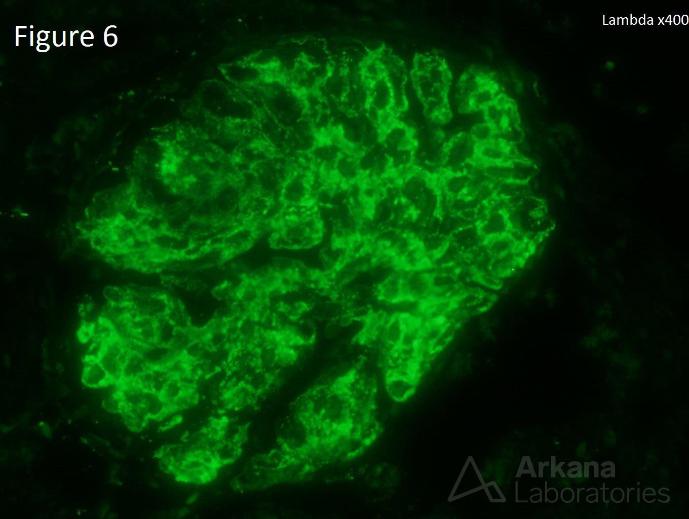 Lupus Nephritis