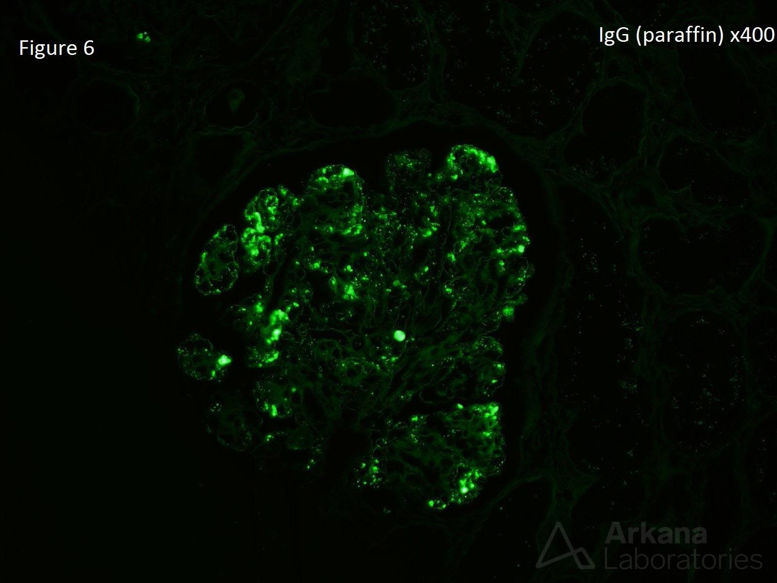 Cryoglobulinemic Glomerulonephritis