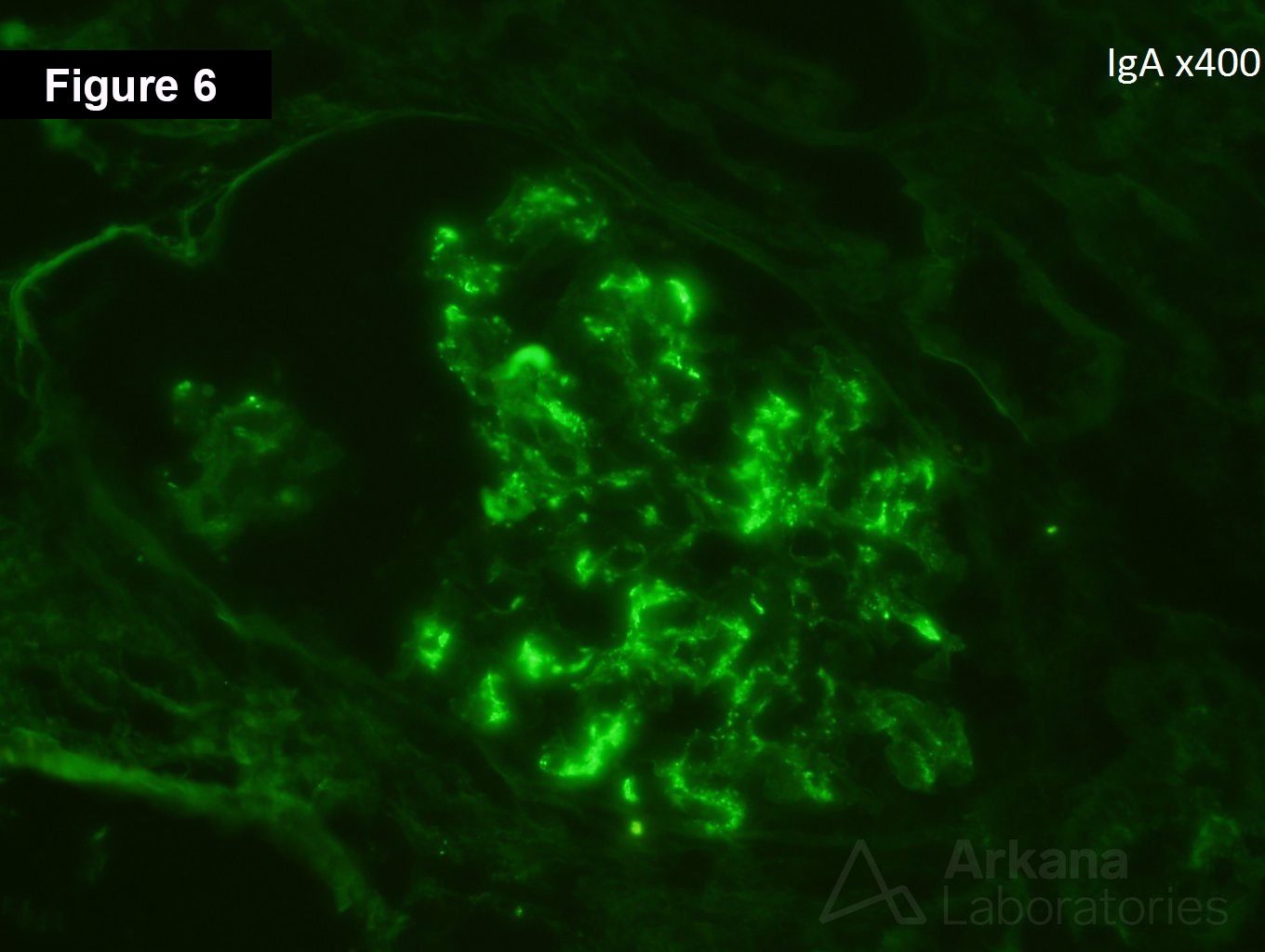 Crescentic IgA nephropathy