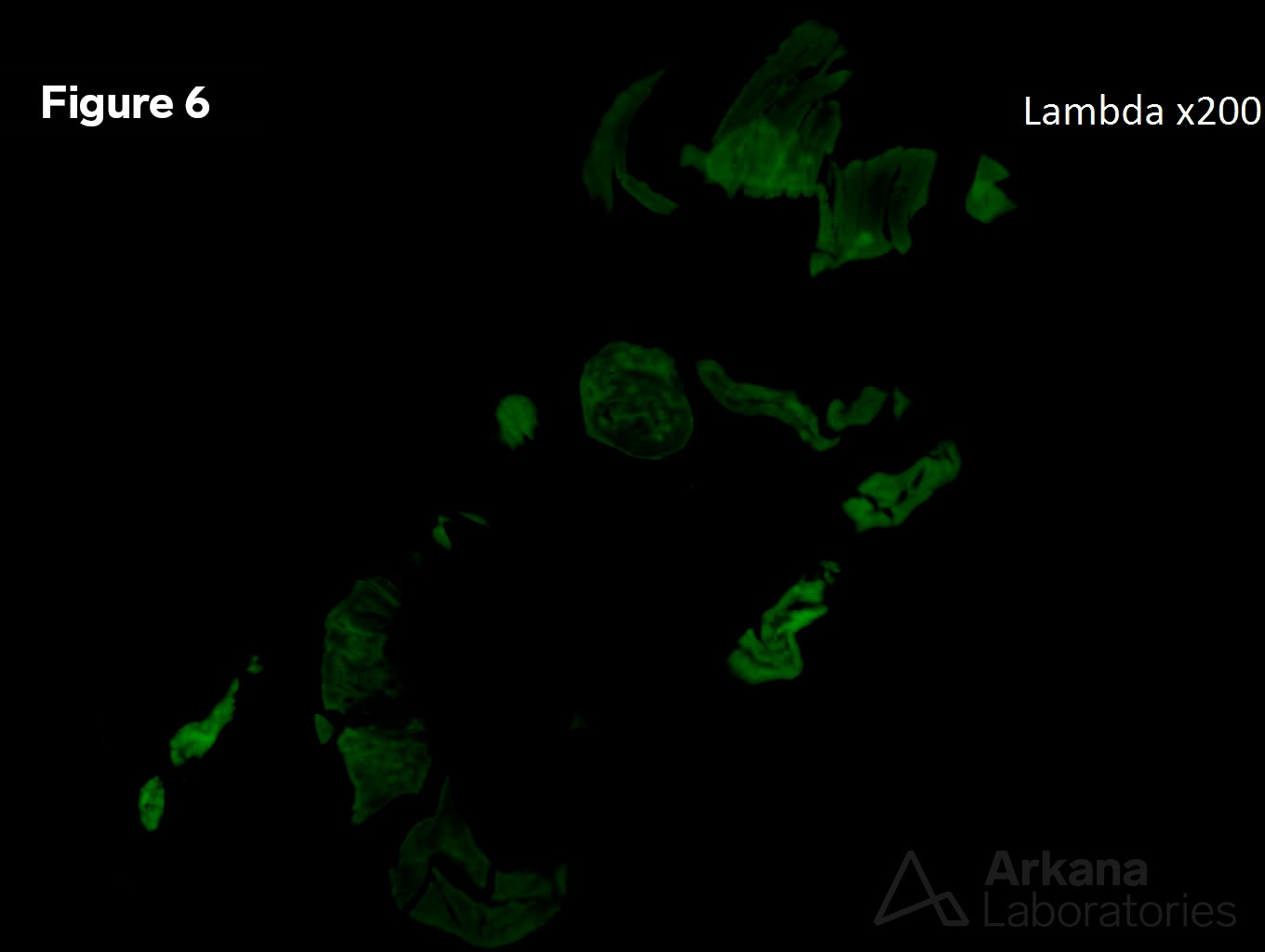 Light Chain Cast Nephropathy