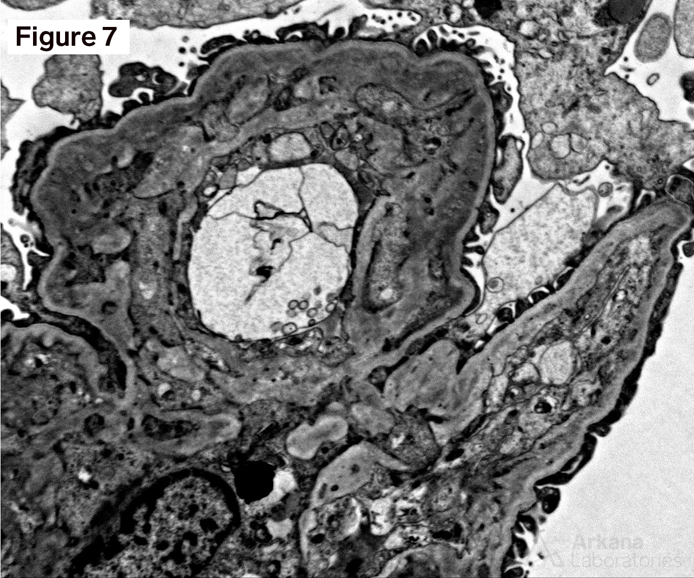 VEGF Inhibitor