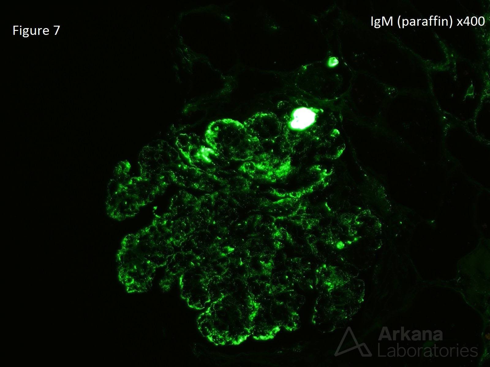 Cryoglobulinemic Glomerulonephritis