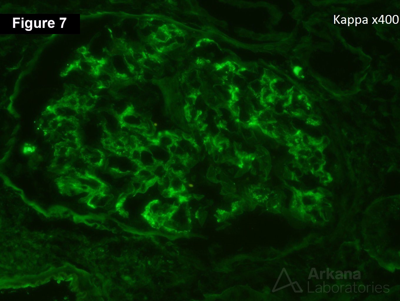 Crescentic IgA nephropathy