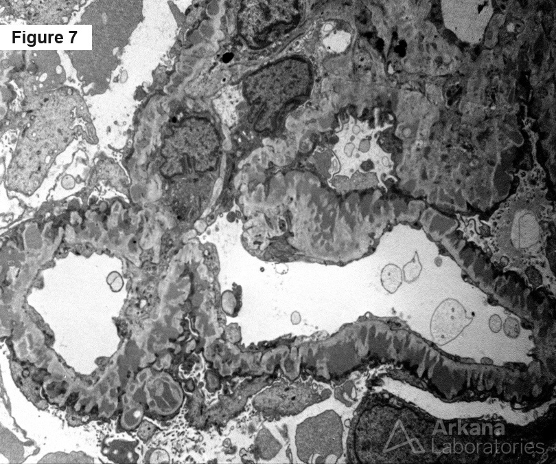 Membranous Nephropathy After Transplantation
