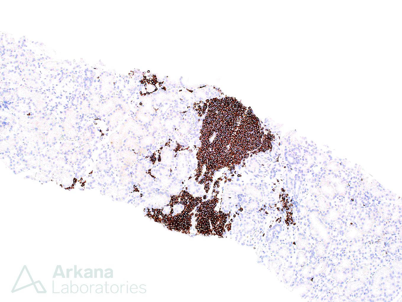 renal biopsy showing proteinuria