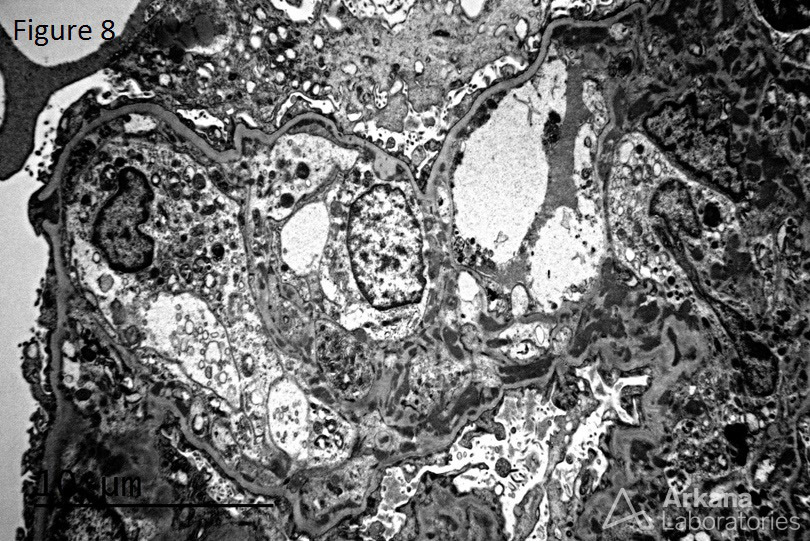 EM imaging from a renal biopsy