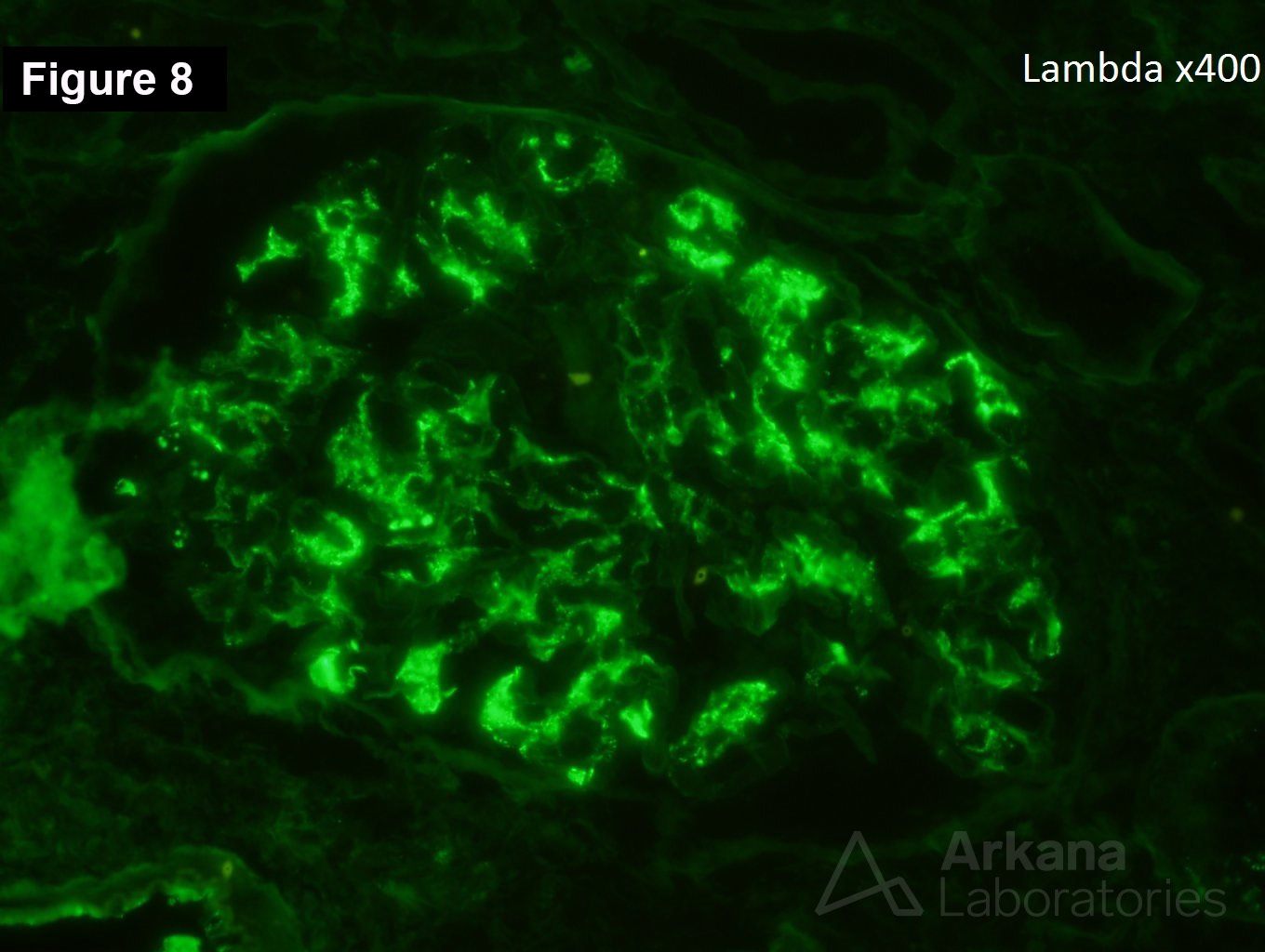 Crescentic IgA nephropathy