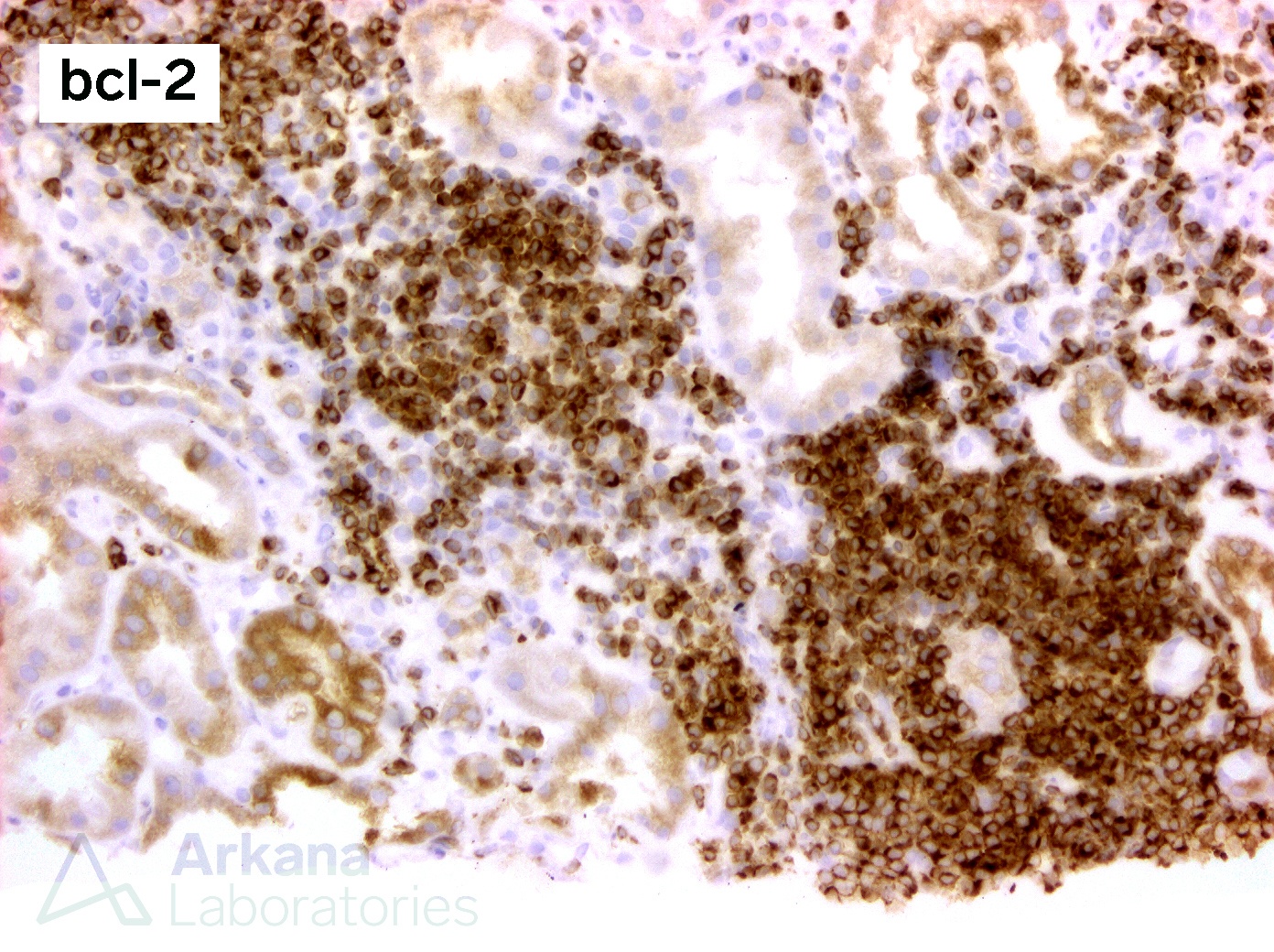 proteinuria in renal biopsy