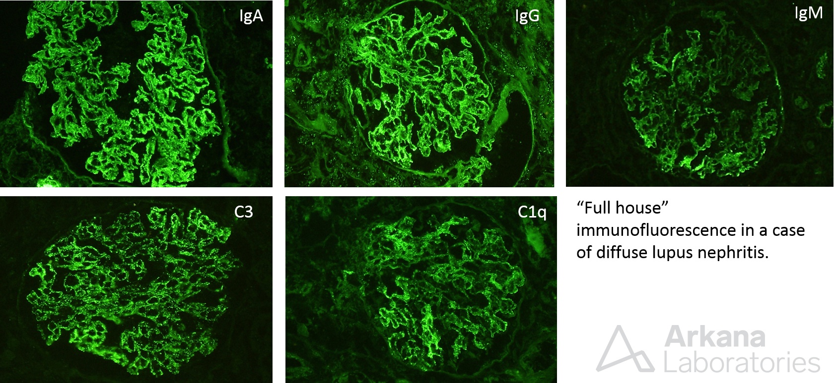 lupus nephritis imaging