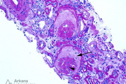 Obsolescent Pattern in Glomerulosclerosis