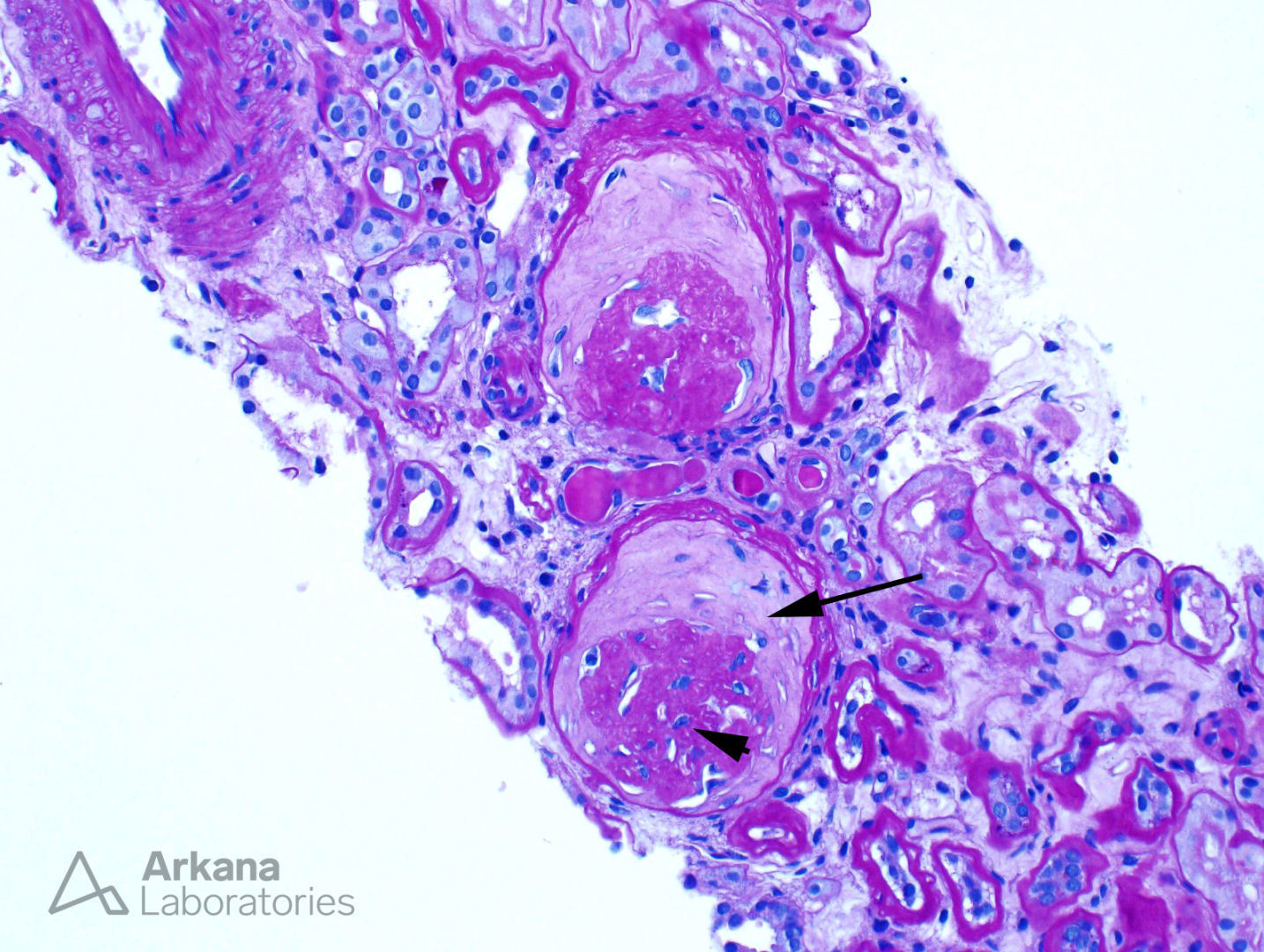 Obsolescent Pattern in Glomerulosclerosis