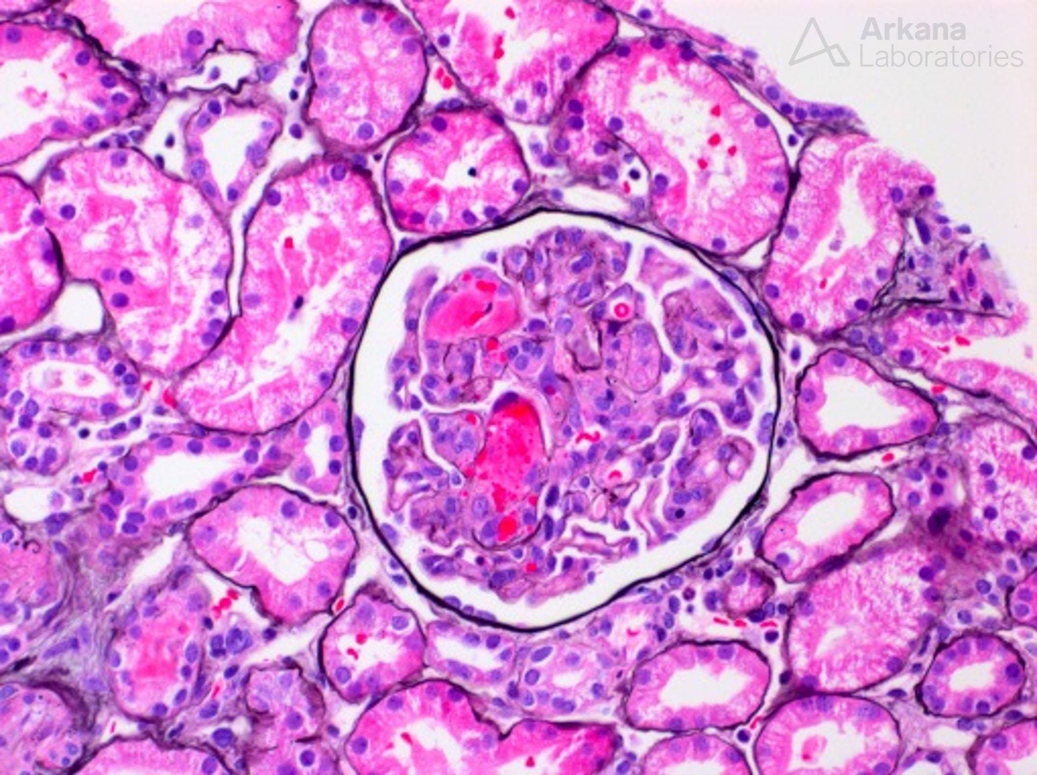 Thrombotic Microangiopathy imaging