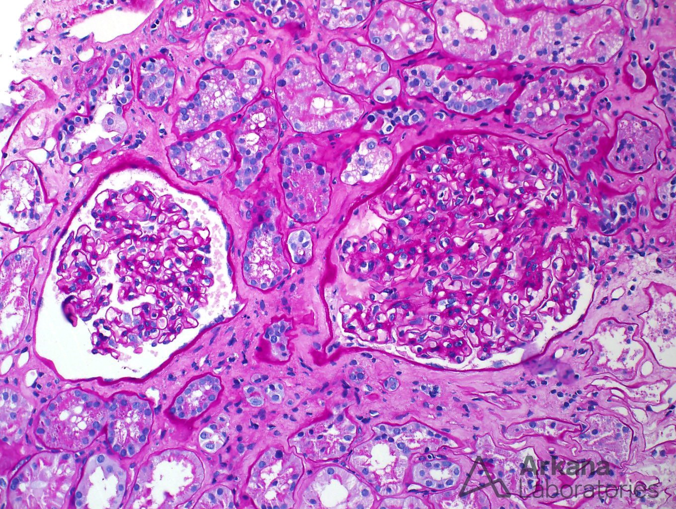 Amyloid deposits were not identified in the glomeruli under light stain image