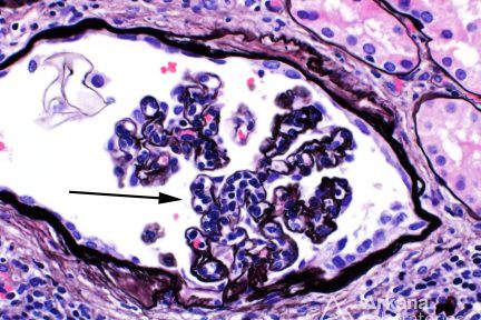 Glomerulitis