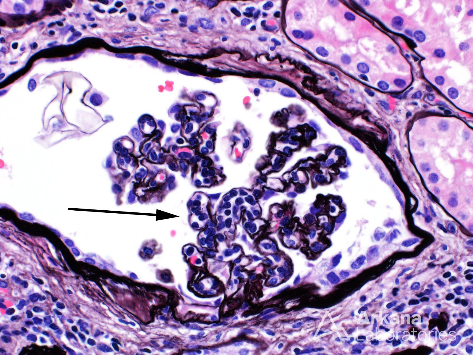 Glomerulitis