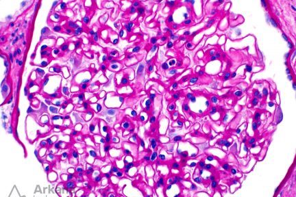 Glomerulomegaly