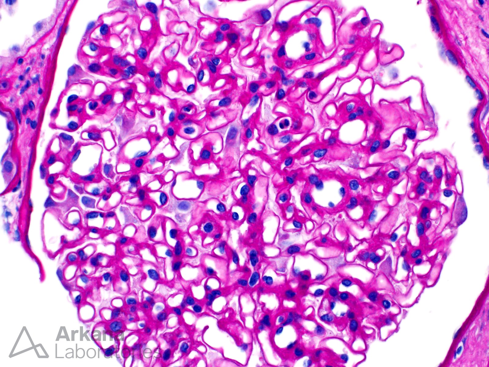 Glomerulomegaly