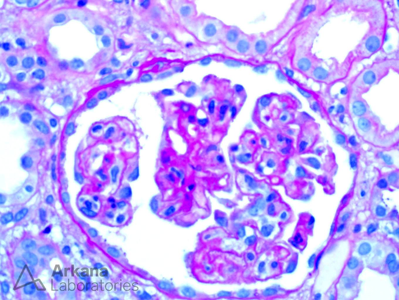 acute antibody-mediated rejection