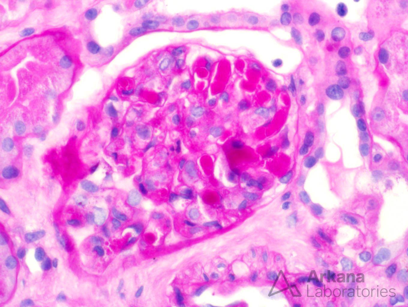 cryoglobulinemia