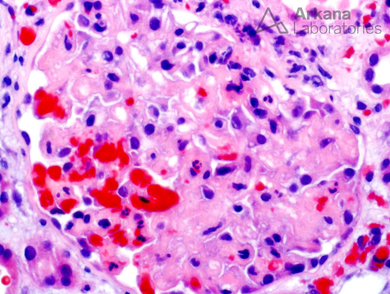 renal biopsy from Arkana Laboratories