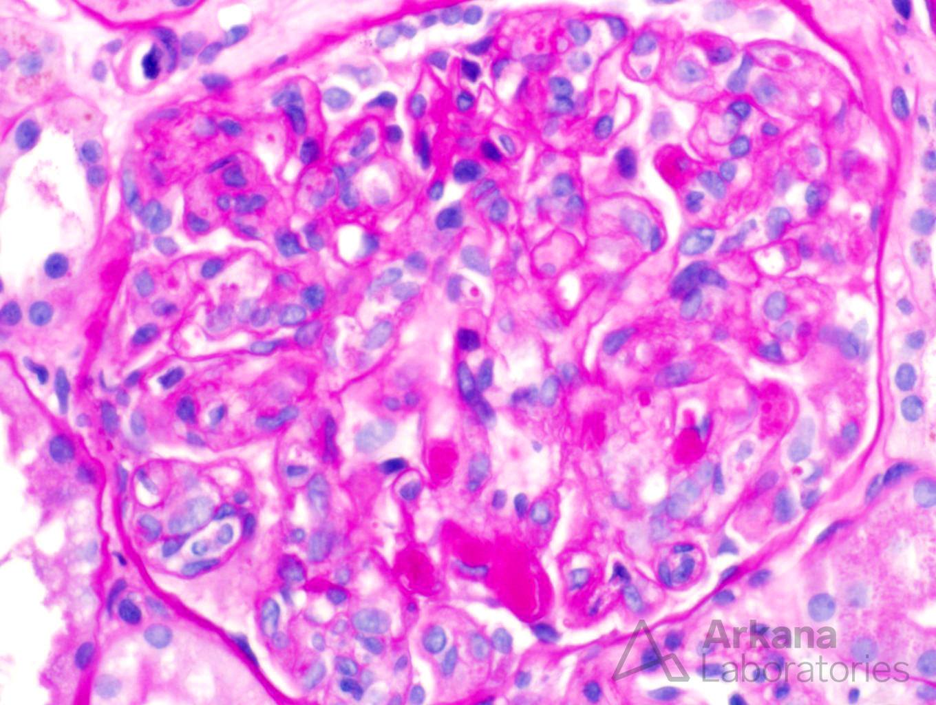 cryoglobulinemia