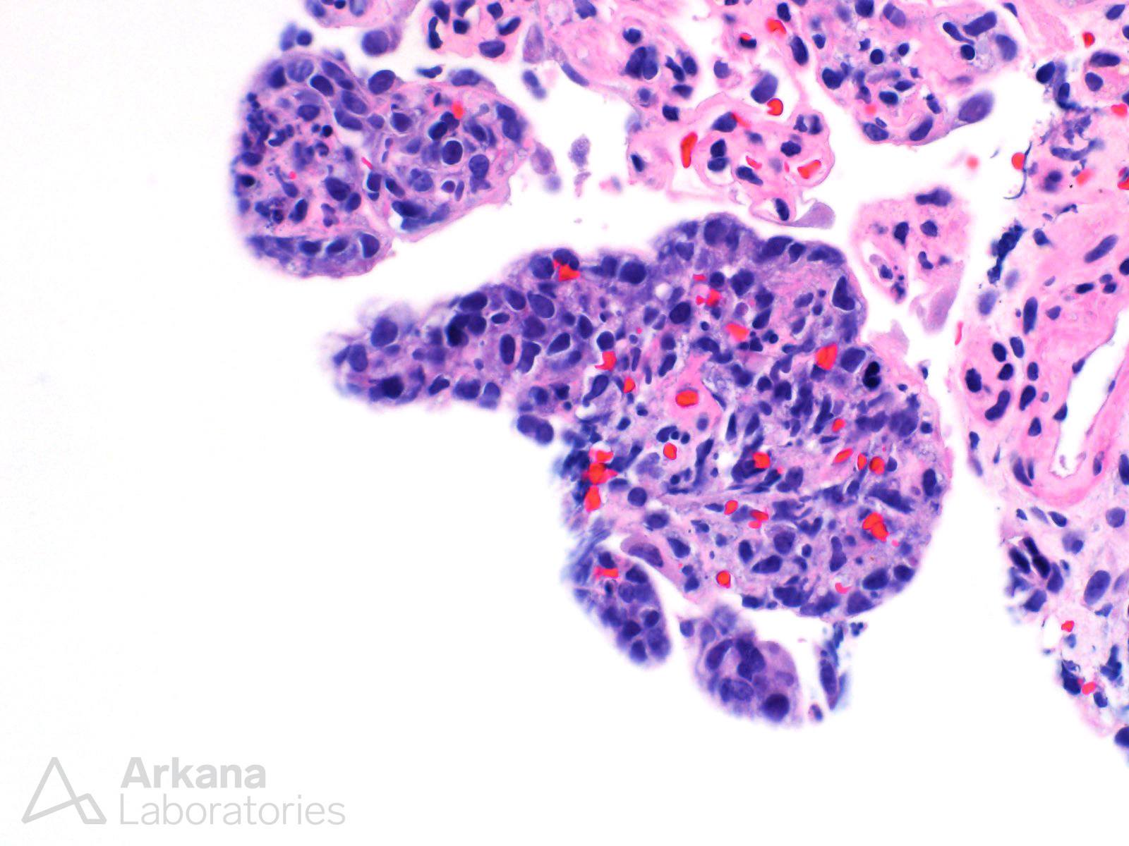 Large B-Cell Lymphoma