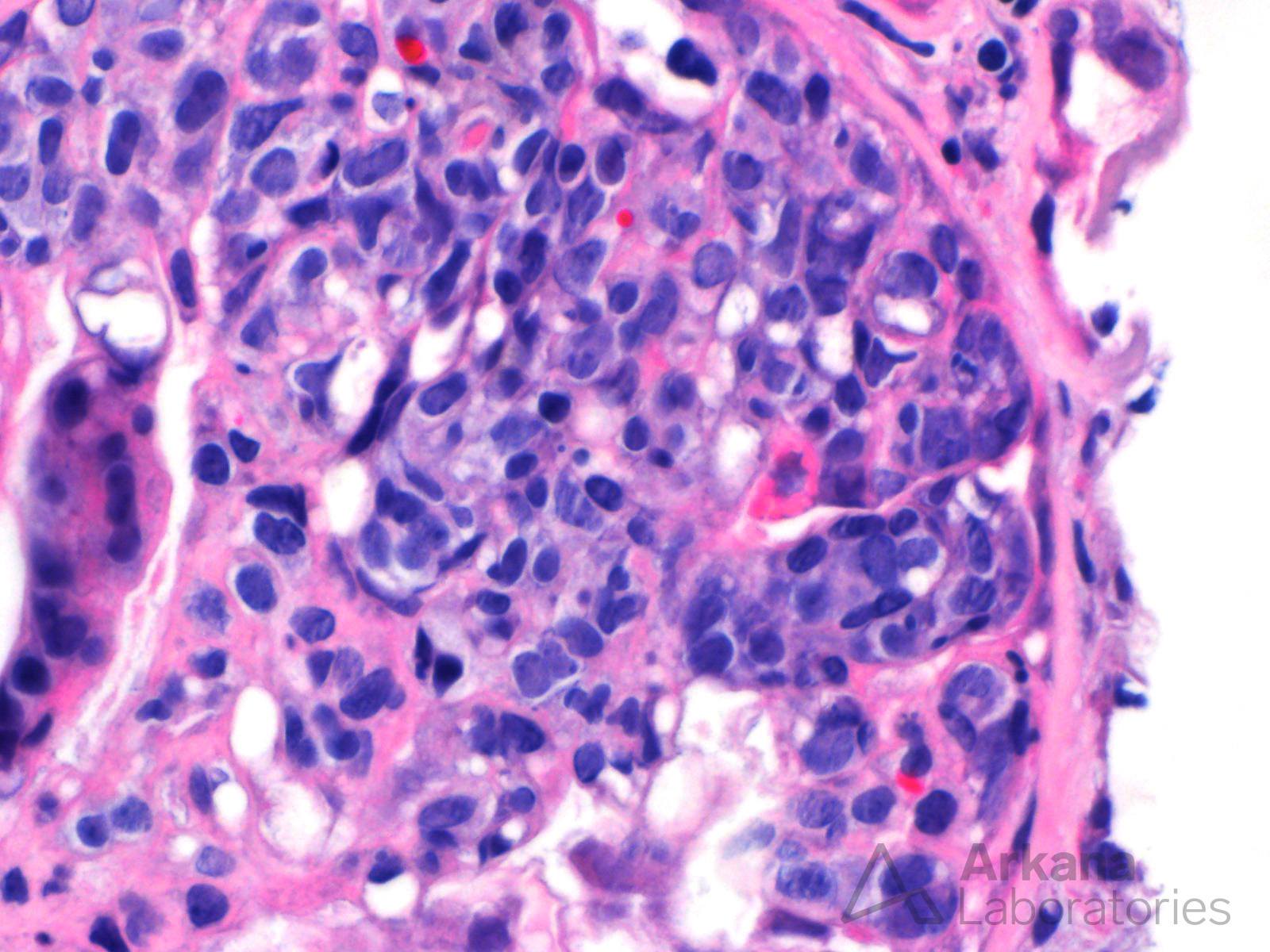 Large B-Cell Lymphoma