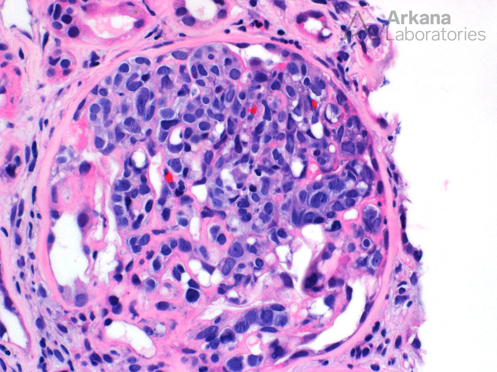 Large B-Cell Lymphoma