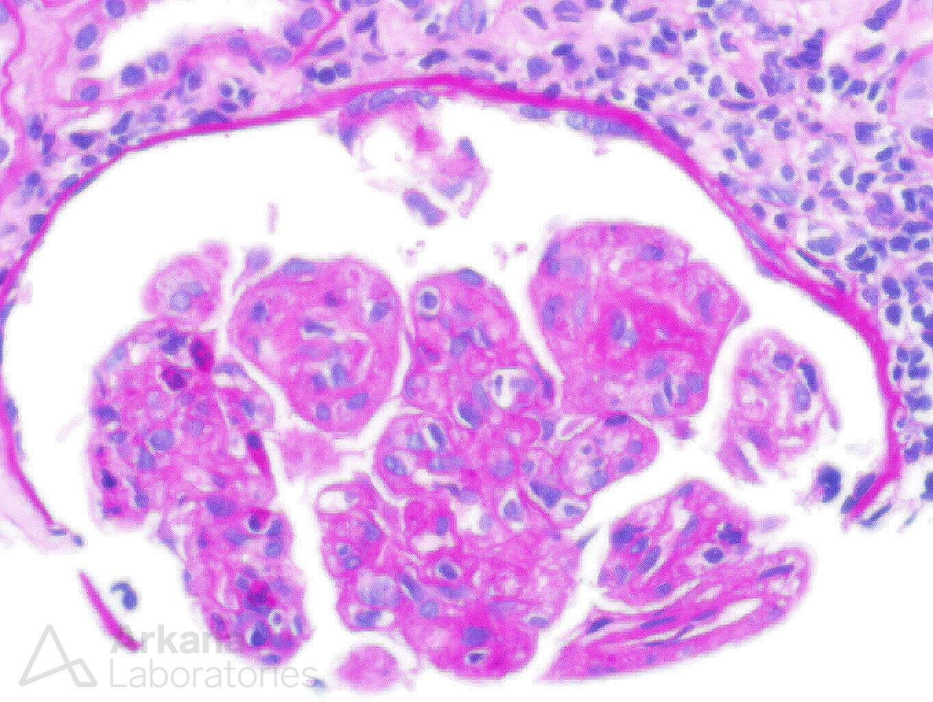 type I cryoglobulinemia