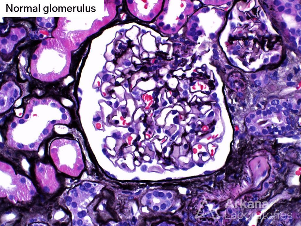 Glomeruli, atypical pattern, segmental sclerosis, fibrous crescent, arkana laboratories