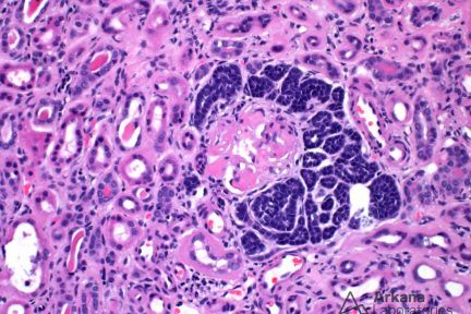 Embryonal Hyperplasia of Bowman's Capsule Epithelium