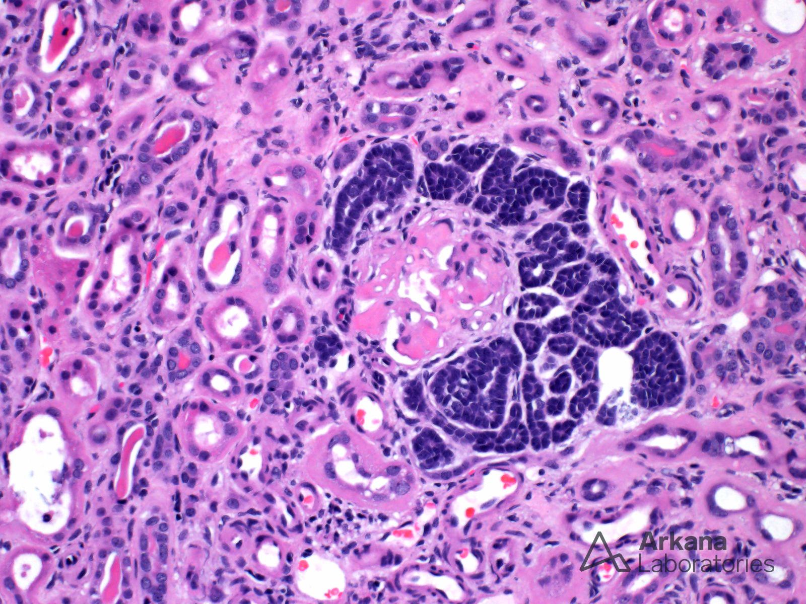 Embryonal Hyperplasia of Bowman's Capsule Epithelium