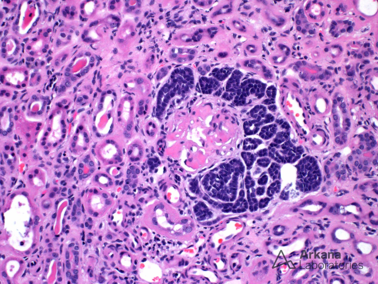 embryonal hyperplasia/metaplasia of Bowman’s