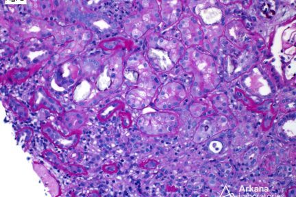 Oxalate Nephropathy