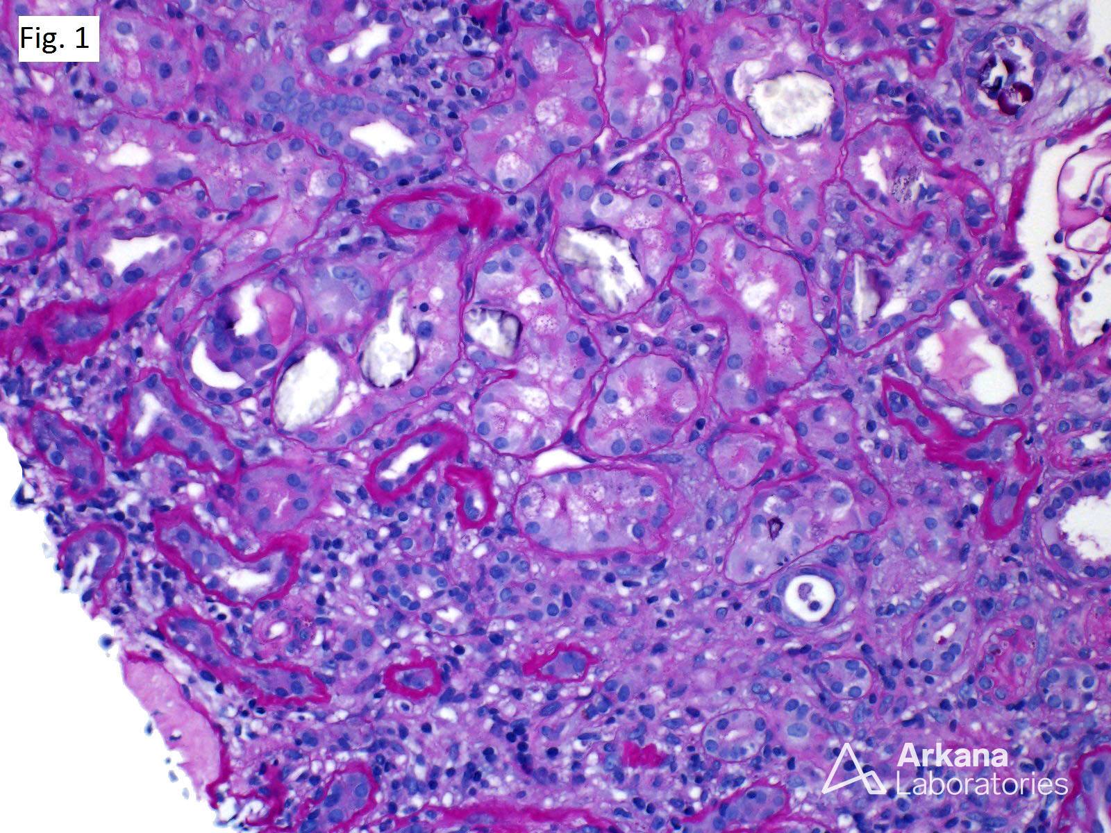 Oxalate Nephropathy