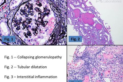 HIV-Related Kidney Disease, HIVAN, HIVICK