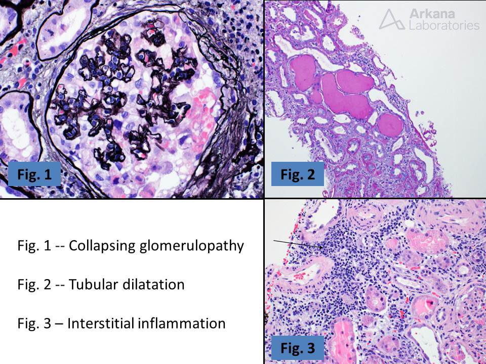 HIV-Related Kidney Disease, HIVAN, HIVICK