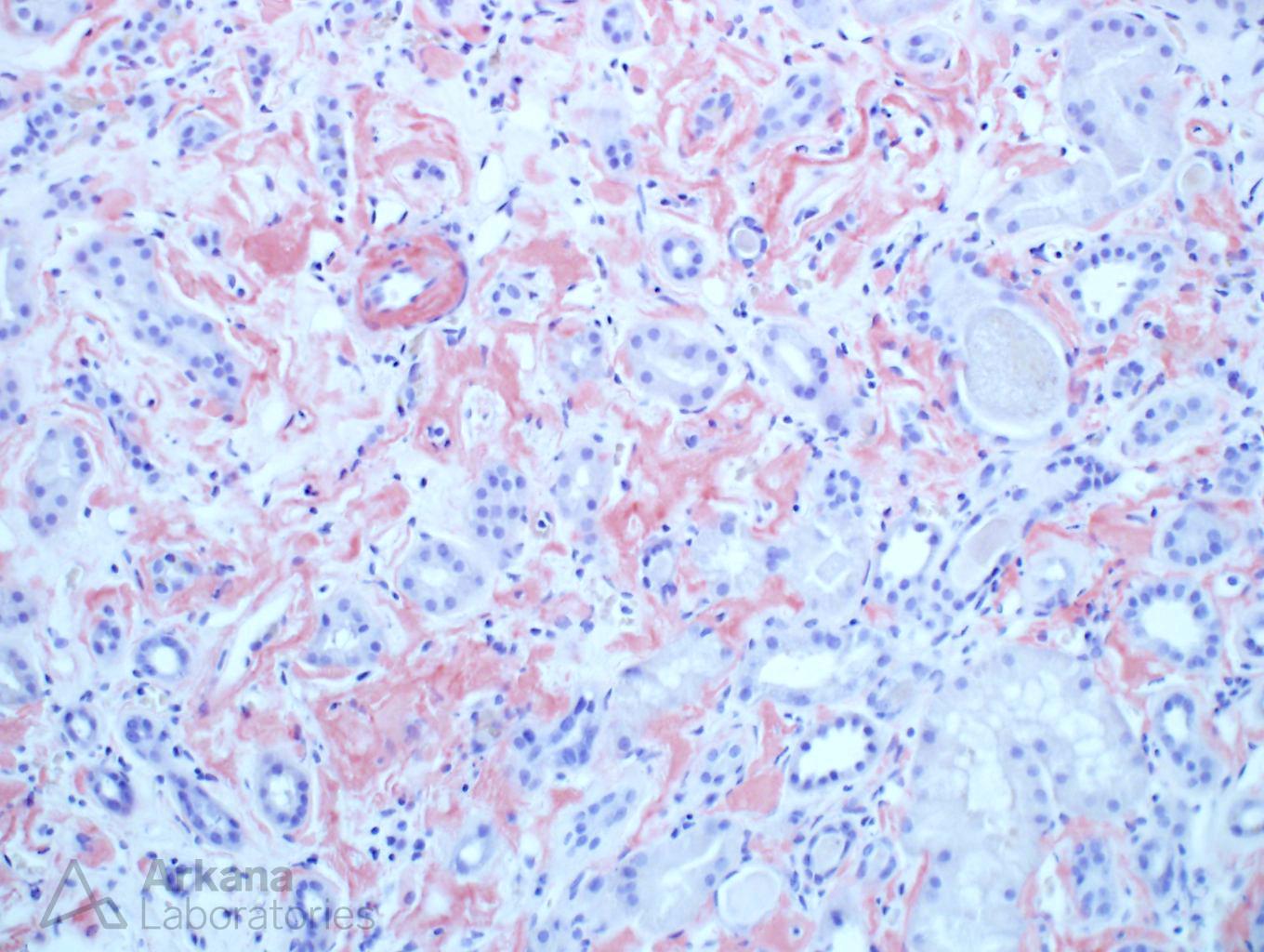 Amyloidosis, ALect2-Type