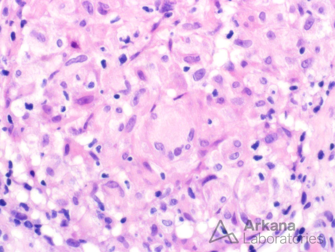 Granulomatous Interstitial Nephritis